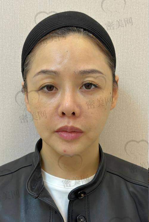 口服玻尿酸测评报告来啦