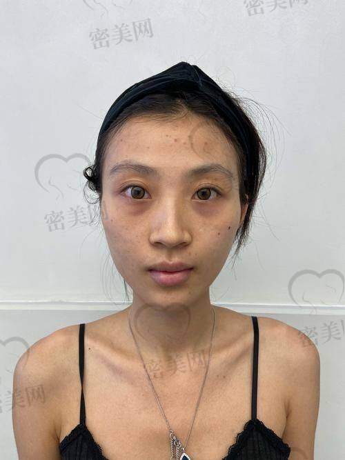 艾莉薇玻尿酸多少钱一支？