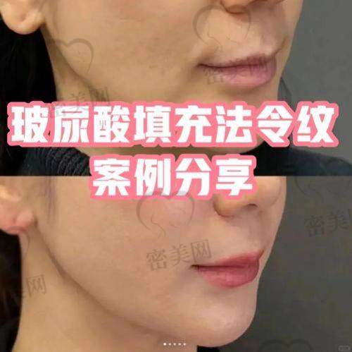 医美项目：去除法令纹的“大招”