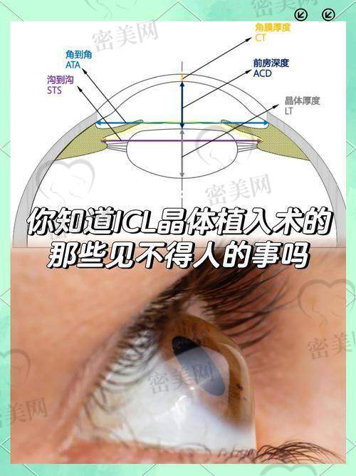 兰州普瑞眼科白内障、青光眼等其他手术费用也公开透明