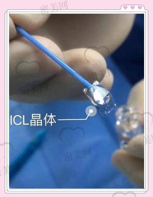 兰州普瑞眼科OK镜和角膜塑形镜价格：适合青少年控制近视