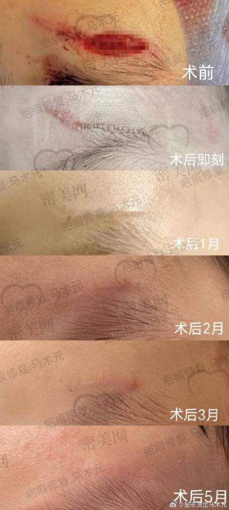 汕头华美医疗美容门诊部：美容缝合结合生物膜处理新思路