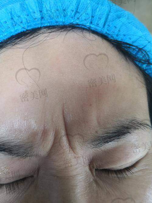 简单消除抬头纹方法