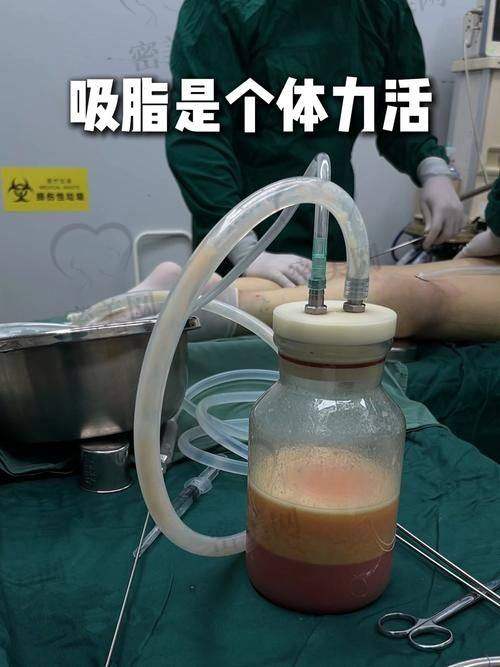 上海伯思立整形宋建星全身吸脂：口碑评价超棒