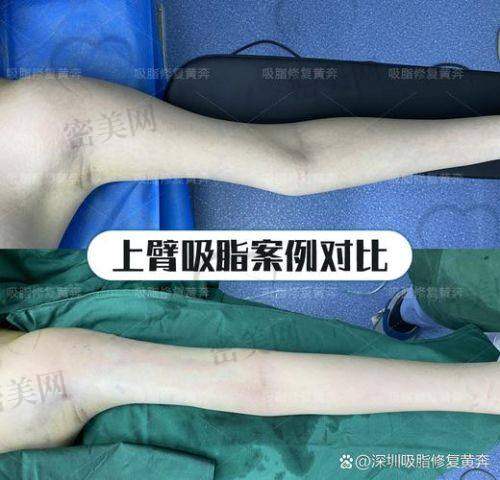 上海伯思立整形：全身吸脂的优质平台