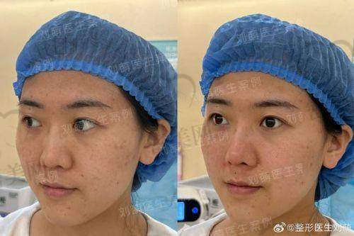 与手术隆鼻对比有啥优缺点？
