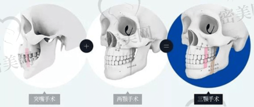 脸颊凹陷填充的风险与注意事项