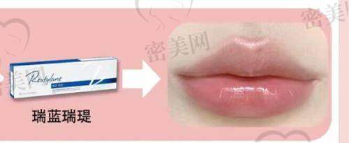 嘟嘟唇注射有啥危害？