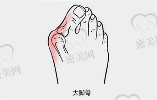 北京朝阳医院：区域“明星”的拇外翻逆袭之路