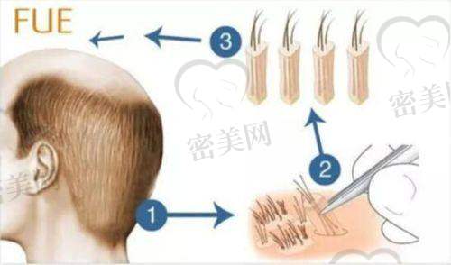 福州恒博植发机构
