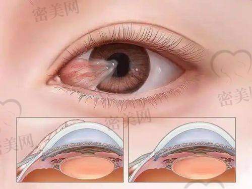 赣南医学校第一附属医院眼科——视力手术费用波动趋势