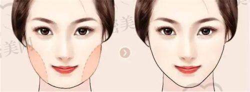 成效维持时间，能撑多久？