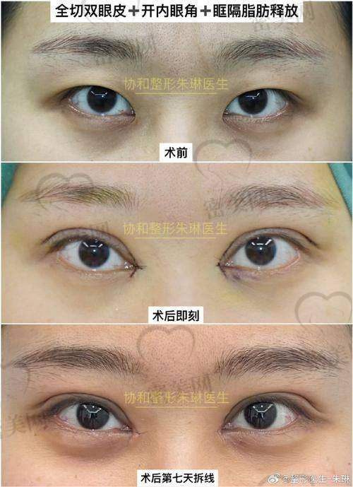 上海许炎龙双眼皮口碑怎么样？深入剖析许炎龙技术、案例及双眼皮价格！ 