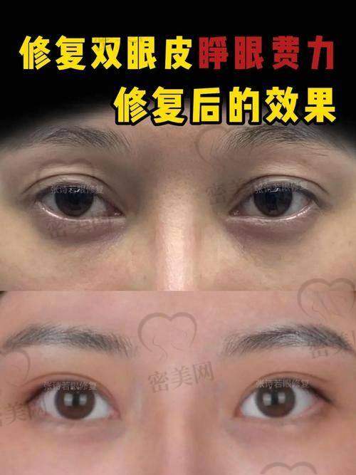 上海爱尚丽格张诗若眼部修复：真人实例大震撼