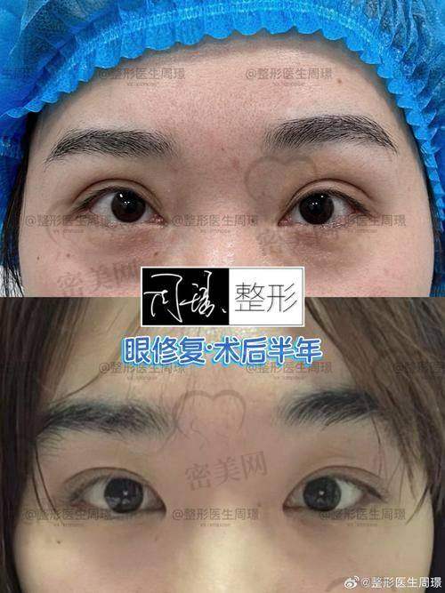 北京晶美医疗美容魏志香：眼袋修复的优势大揭秘