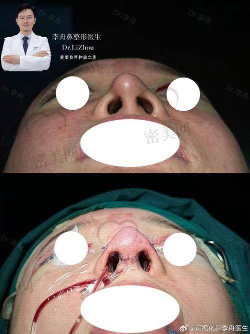 上海伯思立整形王艳鼻修复：真人实例见证奇迹