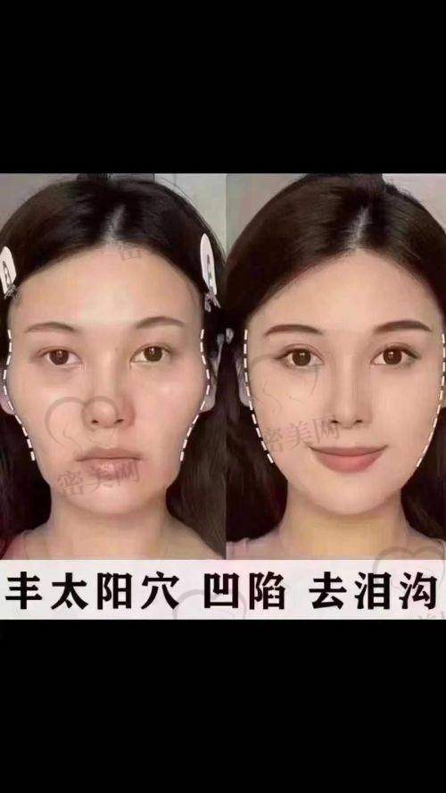 重庆华美整形美容医院：蜂巢结构+PRF技术双重保护