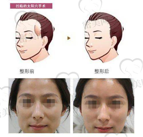 重庆填太阳穴优质医院排名一览