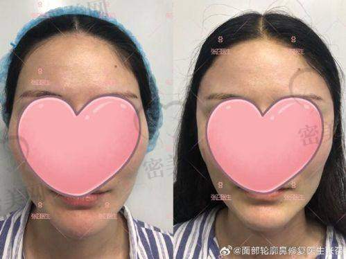 重庆韩美整形美容医院：术中监测系统+线提升融合
