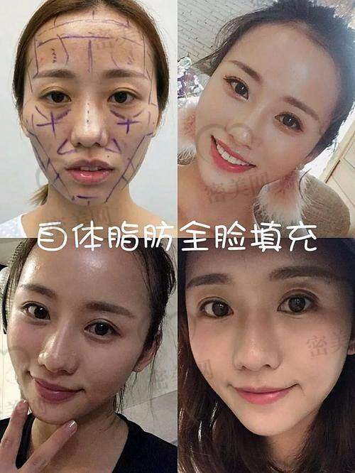 广州美莱医疗美容——羊城手部填充之星