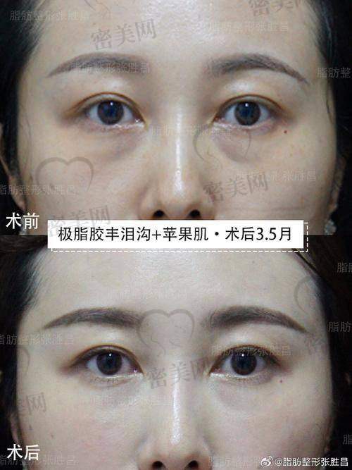 北京圣嘉新医疗美容医院——手部填充的“宝藏医院”