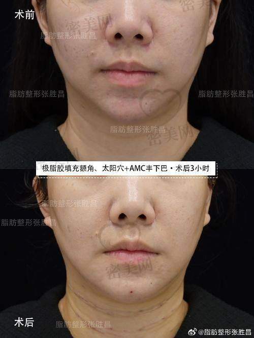 深圳富华医疗美容医院——鹏城手部填充先锋