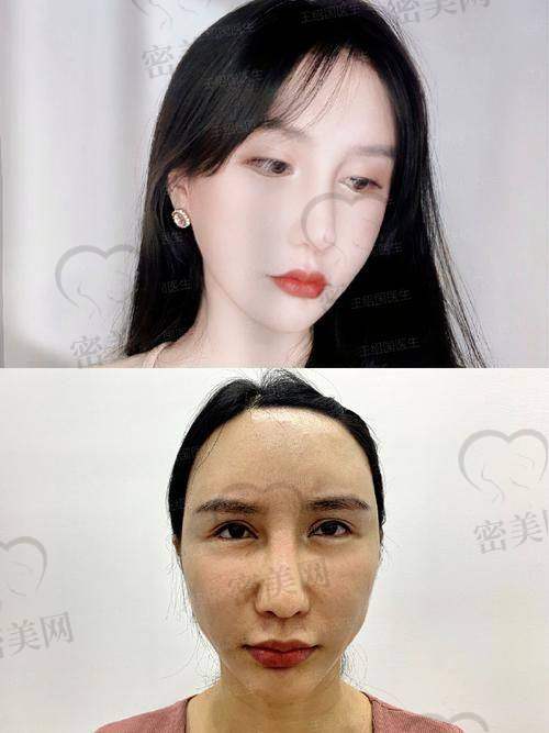北京加减美医疗美容——手部填充的“秘密武器”