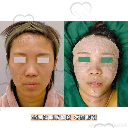 成都艺星医疗美容——蓉城手部填充之花