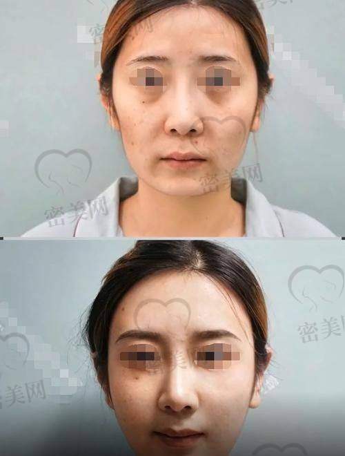北京禾美嘉医疗美容——开启手部饱满之旅