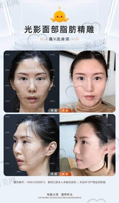 上海伯思立整形顾建成：1W 起的单部位脂肪填充，开启变得更美“钞能力”