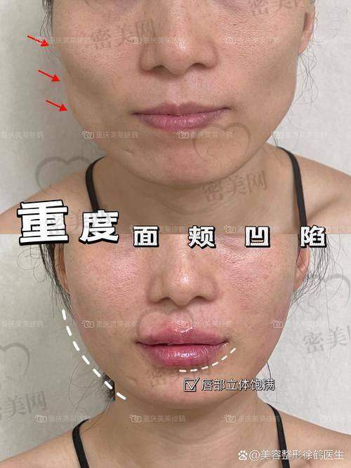 上海伯思立整形顾建成：真人实例见证美丽奇迹