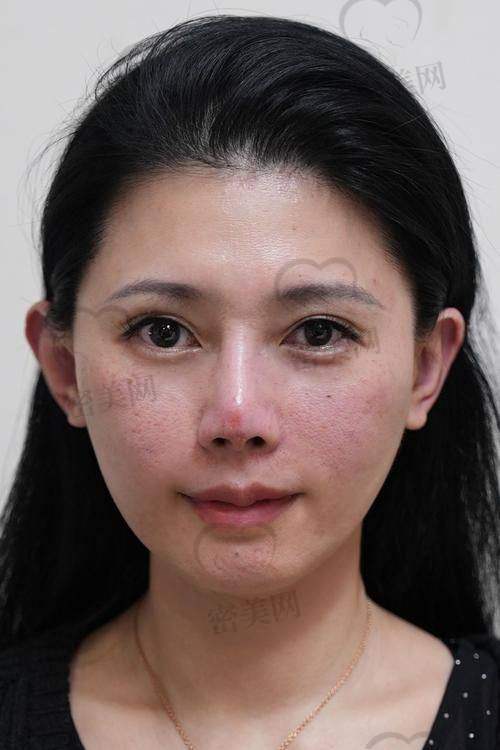 填充有啥危害和副作用？