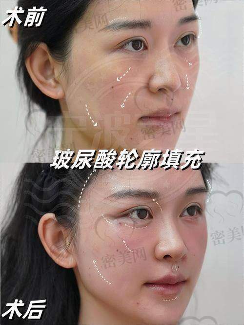 玻尿酸填充的其他小秘密