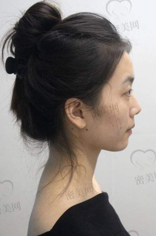 玻尿酸填充下巴多少钱一针？