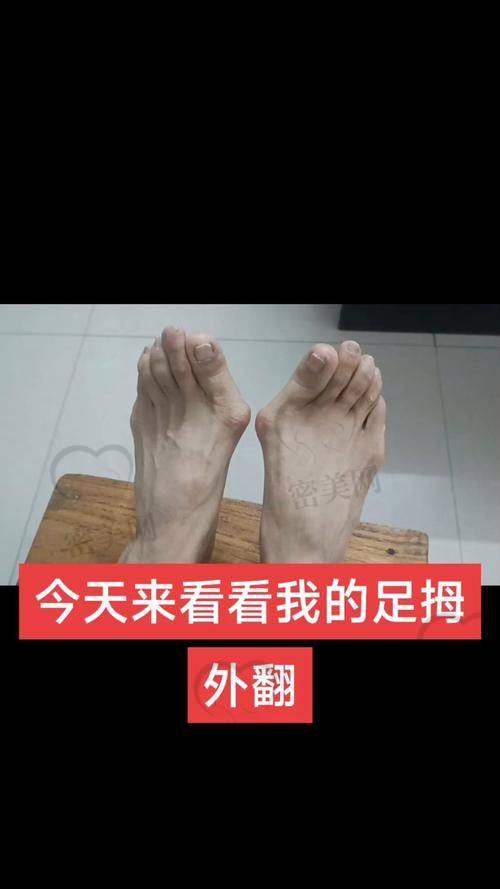 北京积水潭医院：骨科界“扛把子”的拇外翻攻略
