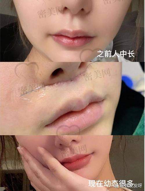 怎么做更省钱？人中缩短术超值攻略来了！