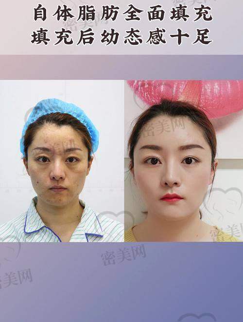 真人实例：见证全方面部脂肪填充的神奇魔力
