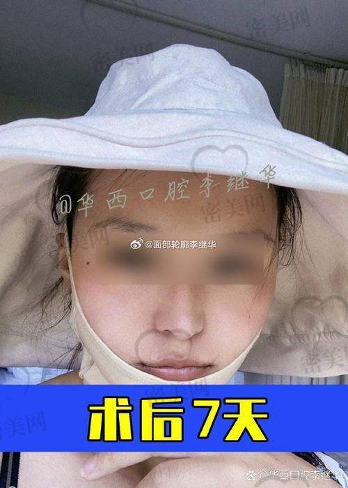 影响整下巴价格的因素