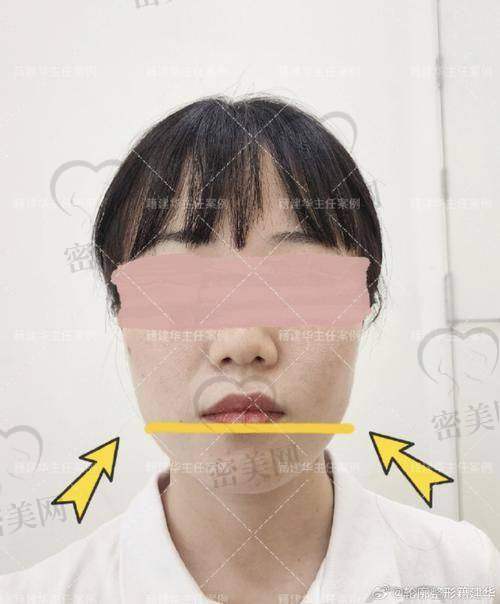 整下巴的风险与注意事项