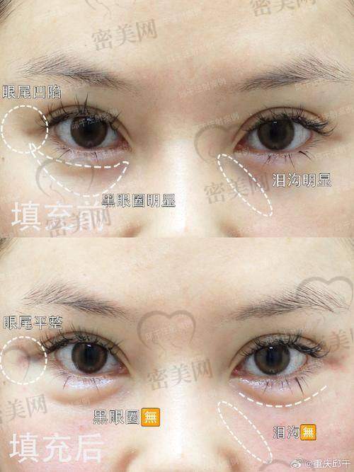 填充眼窝的费用大揭秘