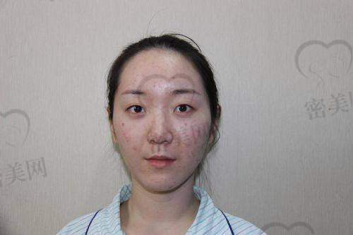 真人实例：北京晶美魏志香双眼皮的“惊艳见证”