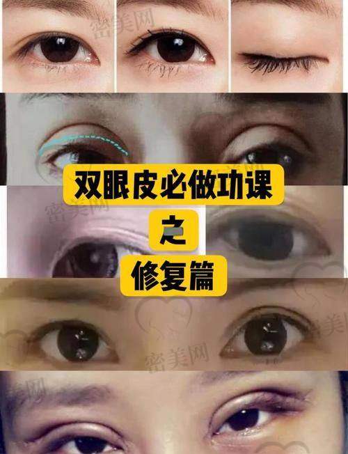 口碑爆棚：上海艺星孙玮奇切开双眼皮，谁做谁夸