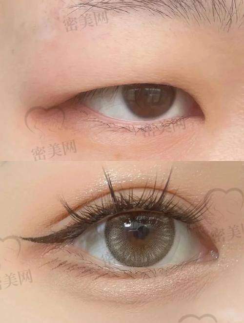 上海时光余东修复双眼皮：靠谱不？