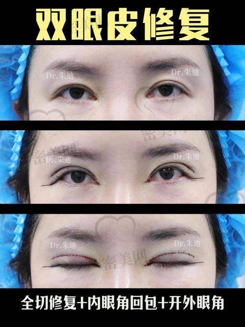 真人实例：见证王玲医生双眼皮修复的神奇魔力