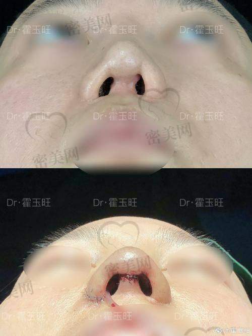 隆鼻失败，我的“噩梦”开始