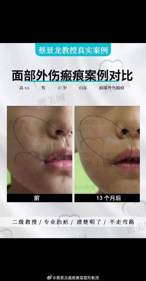 成都疤研疤痕医院有哪些疤痕治疗项目？技术全方面，专治多种疤痕