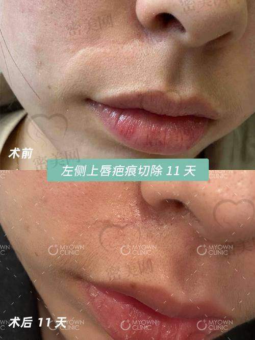 成都疤研疤痕医院治疗真实成效怎么样？看看大家都怎么说