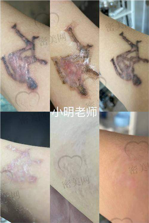 西安壹加壹整形医院：微创双疗法，体验升级