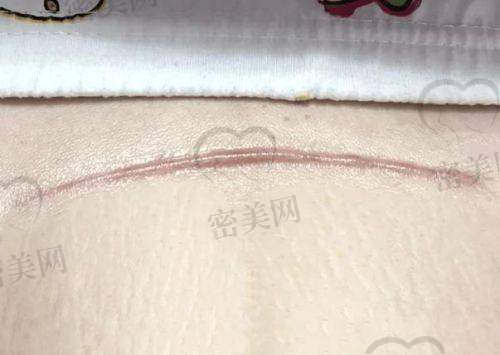 西安米兰柏羽：眼部疤痕治疗灵活精细