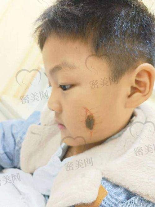 口碑爆棚：北京广济医院陈业忠胎记治疗获赞无数